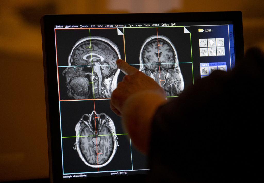 Estudio podría diagnosticar y prevenir enfermedades neurológicas antes de presentar síntomas