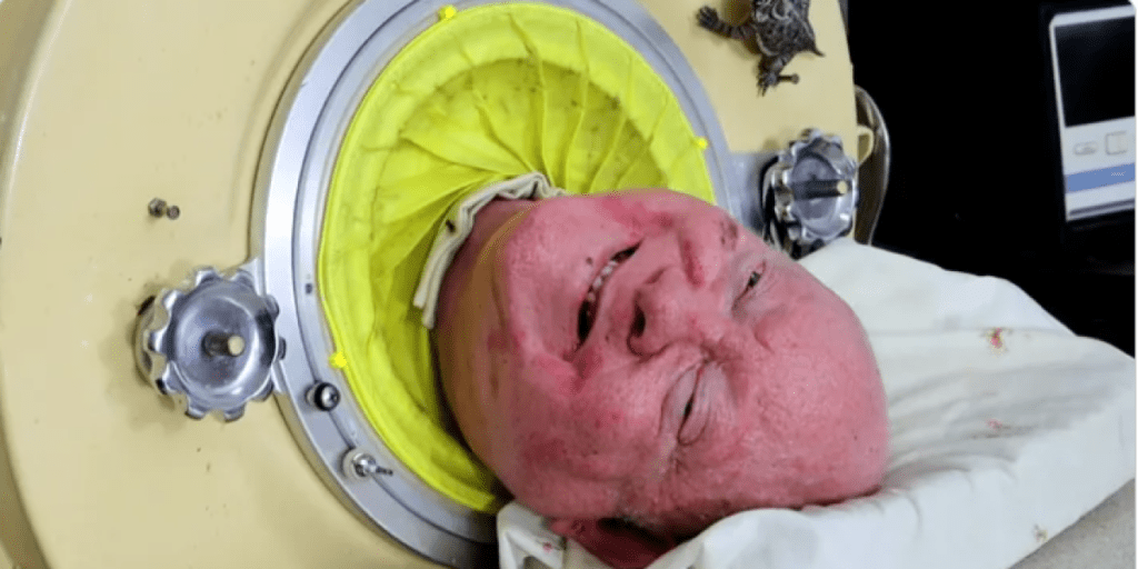 Murió Paul Alexander, el hombre que vivió más de 70 años en un pulmón de acero, eldigital.com..do