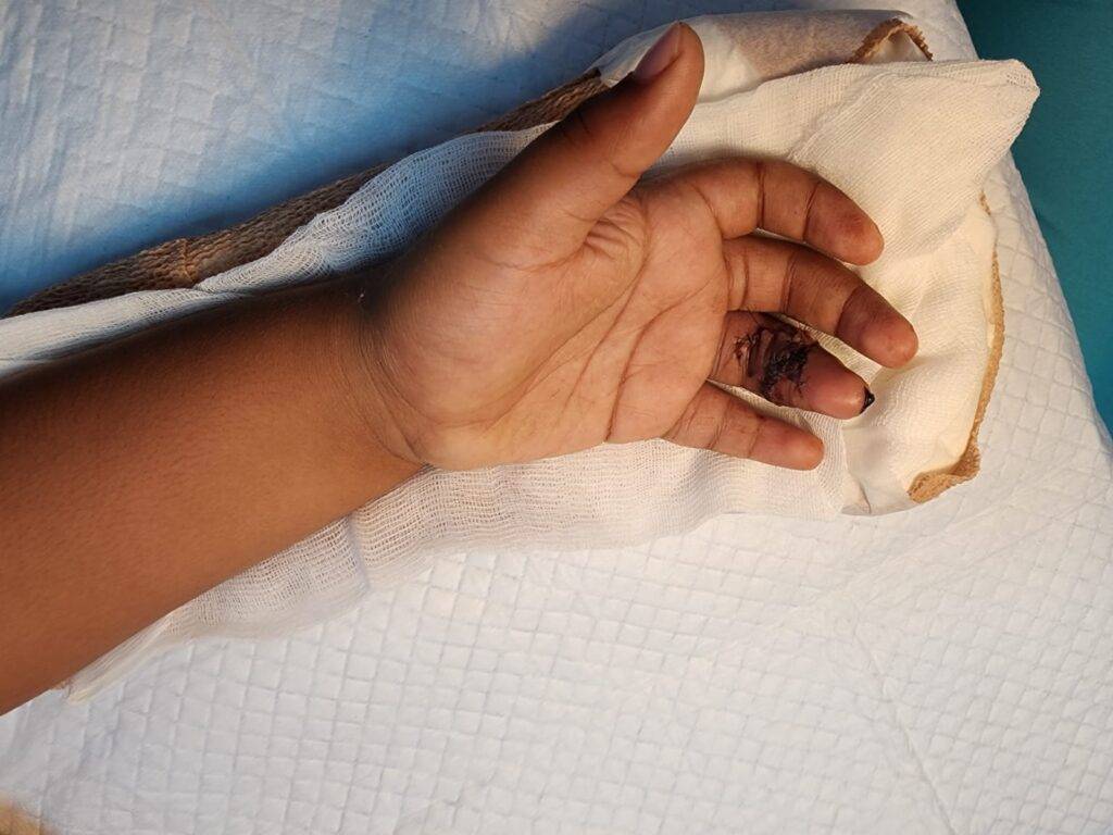 Manoclinic realiza exitoso reimplante de dedo en niño de ocho años, eldigital.com.do