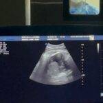 Realizan en Maternidad Los Mina primera Cirugía Fetal en la Red Pública y corrección de Hernia Diafragmática Vía Toracoscopia Asistida de RD, eldigital.com.do