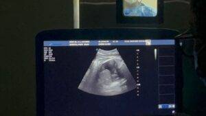 Realizan en Maternidad Los Mina primera Cirugía Fetal en la Red Pública y corrección de Hernia Diafragmática Vía Toracoscopia Asistida de RD, eldigital.com.do