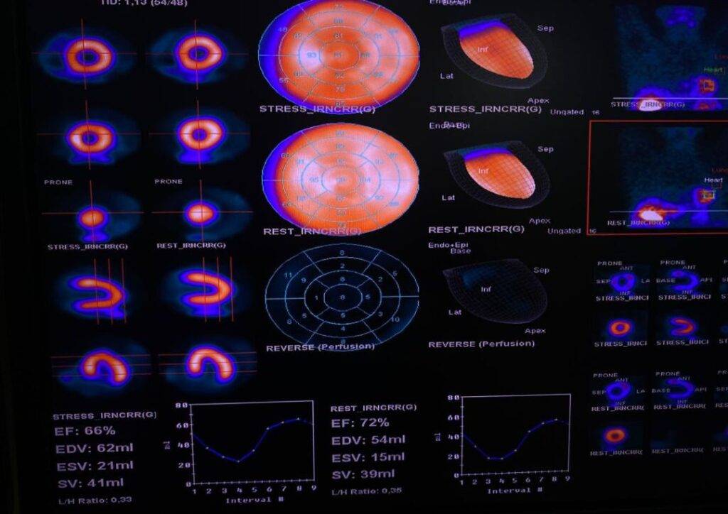 CEDIMAT realiza la primera gammagrafía cardíaca con Regadenoson, eldigital.com.do