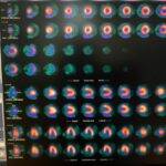 CEDIMAT realiza la primera gammagrafía cardíaca con Regadenoson, eldigital.com.do