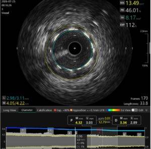 CEDIMAT realiza el primer procedimiento de litotricia intravascular coronaria con balón del país, eldigital.com.do