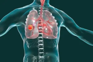 Qué es un adenocarcinoma pulmonar, caso papa León XIV, eldigital.com.do